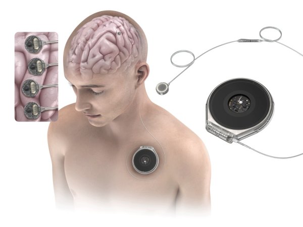 j1.com Chip cerebral: empresa rival de Musk testa primeiro implante em humano; veja como foi